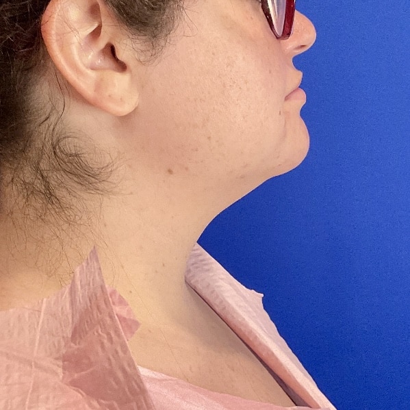 Before Image: Patient Case #7130 - right-side