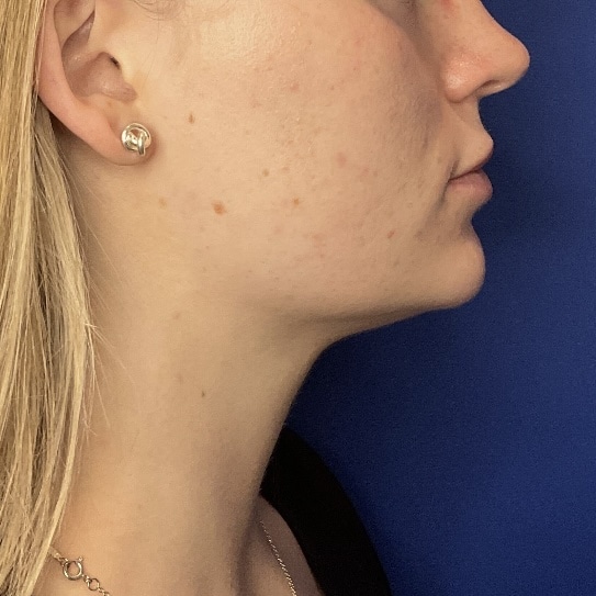 After Image: Patient Case #7140 - right-side