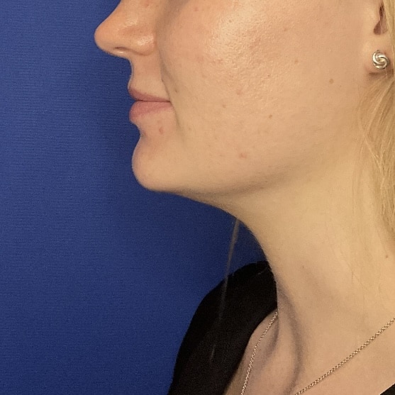 After Image: Patient Case #7140 - left-side