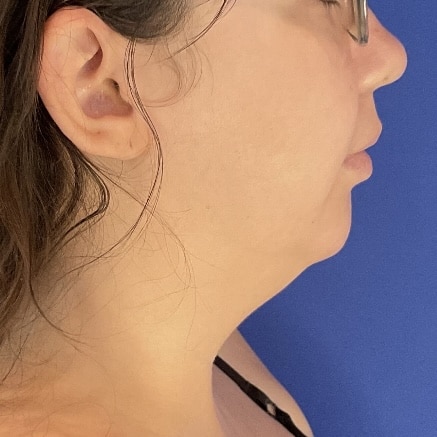 Before Image: Patient Case #7146 - right-side