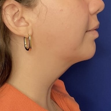 After Image: Patient Case #7146 - right-side