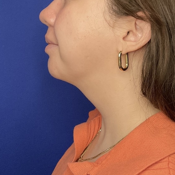 After Image: Patient Case #7146 - left-side