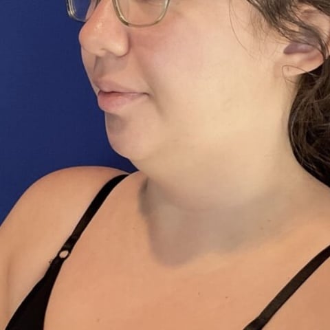 Before Image: Patient Case #7146 - left-front-oblique