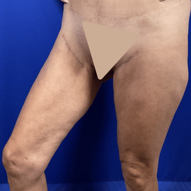 After Image: Patient Case #7193 - left-front-oblique