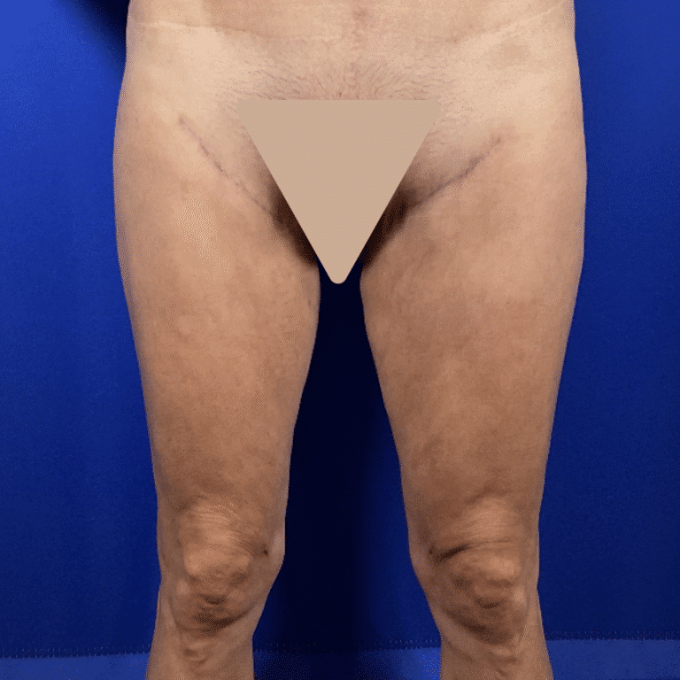 After Image: Patient Case #7193 - front