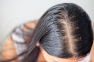 A close-up shot of a woman with thinning hair on her scalp
