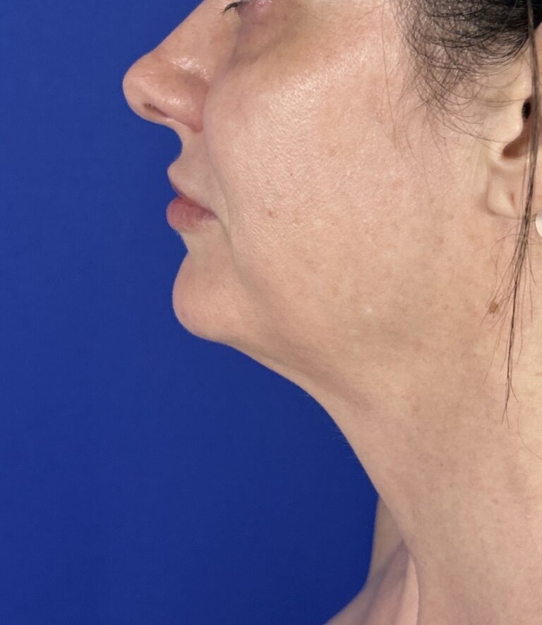 Before Image: Patient Case #7358 - left-side