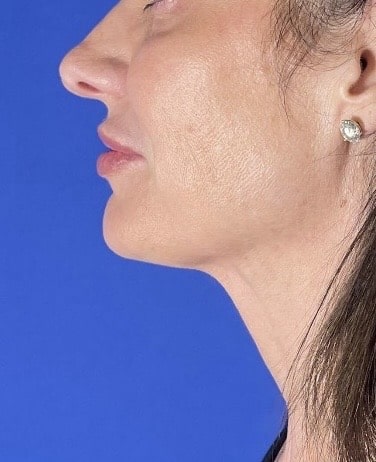 After Image: Patient Case #7358 - left-side